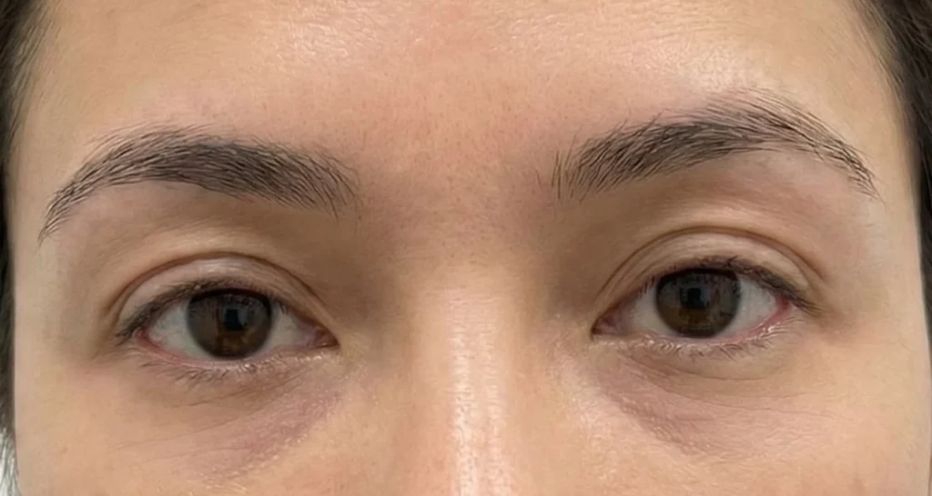 Before and after dark circle treatment with polynucleotides at Zorah Clinic